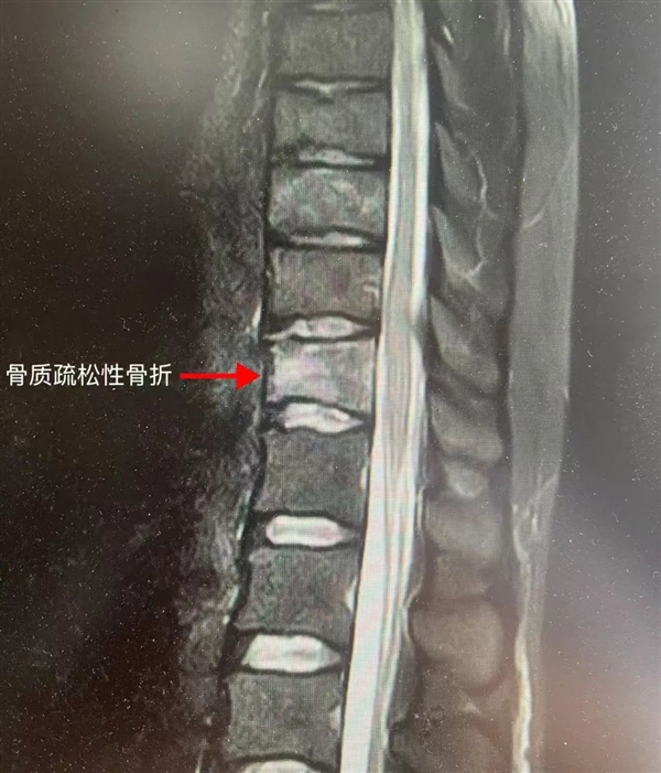 每天4杯咖啡 25岁女孩确诊骨质疏松 弯个腰骨折了